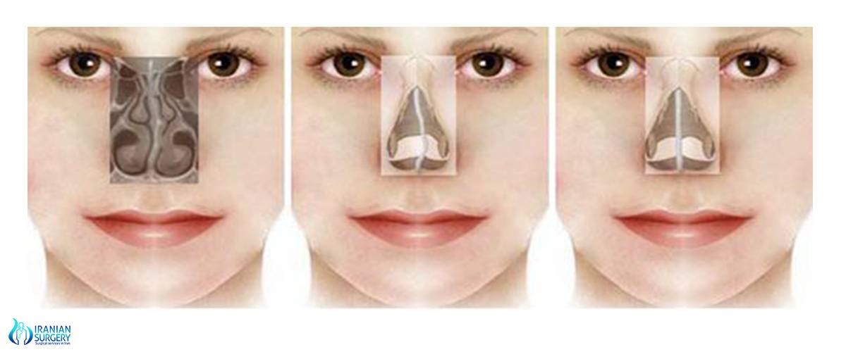Искривление перегородки носа. септопластика
