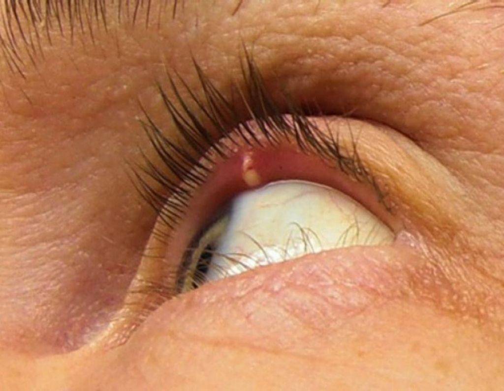 Ячмень на глазу: как быстро вылечить, причины появления, симптомы и профилактика глазного ячменя