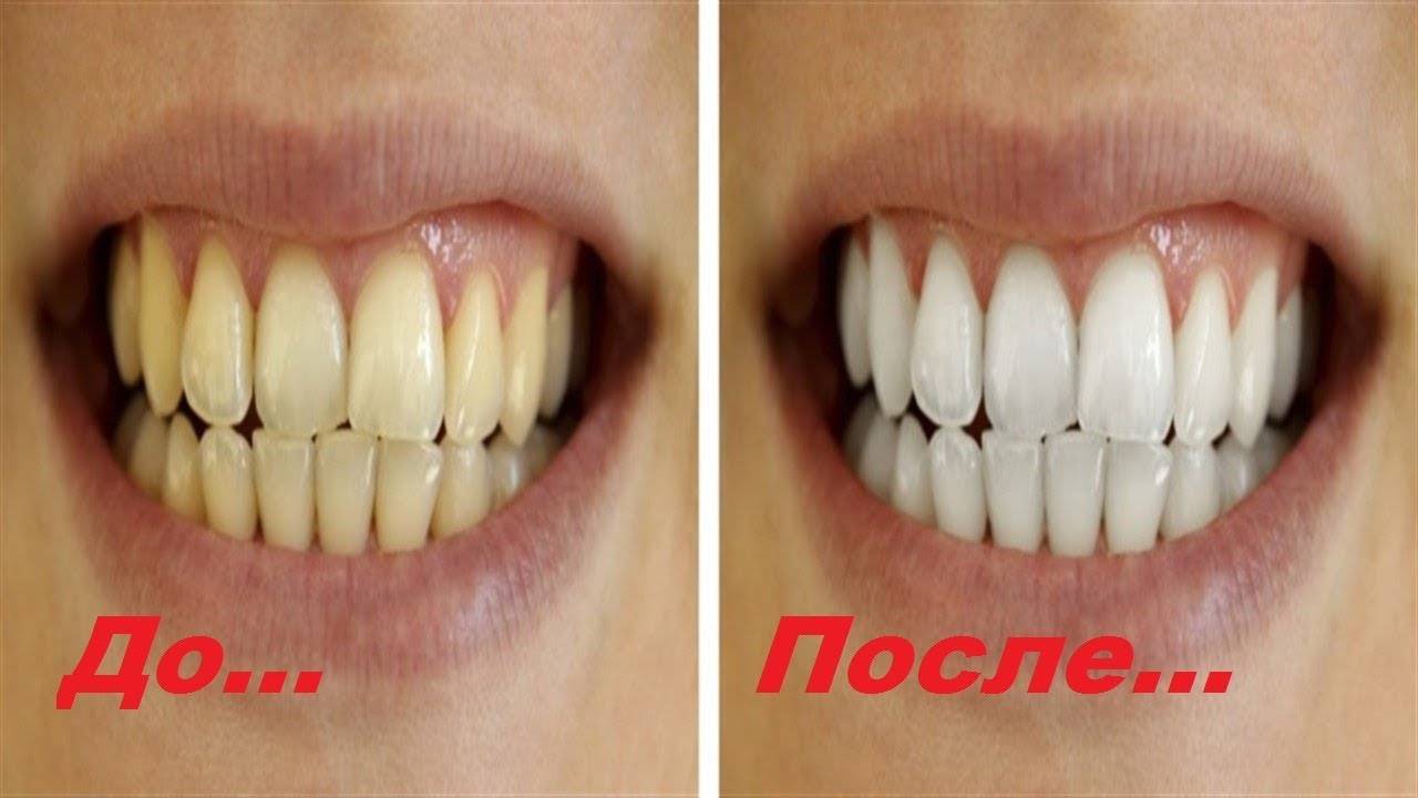 Вредно ли отбеливание зубов – статьи стоматологической клиники «доктор мартин»