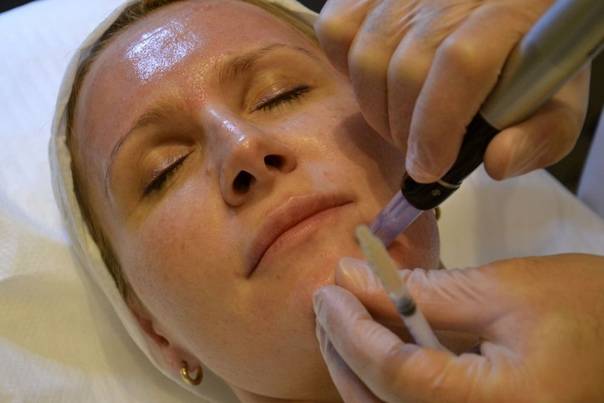 Биоревитализация лица – что это за процедура: эффект «до и после», противопоказания к гиалуроновой кислоте в косметологии, как часто можно делать ревитализацию кожи и что она дает – плюсы и минусы