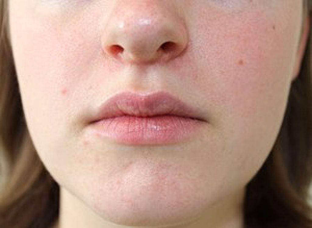 «маскне»: акне, вызванное ношением масок, и другие дерматозы