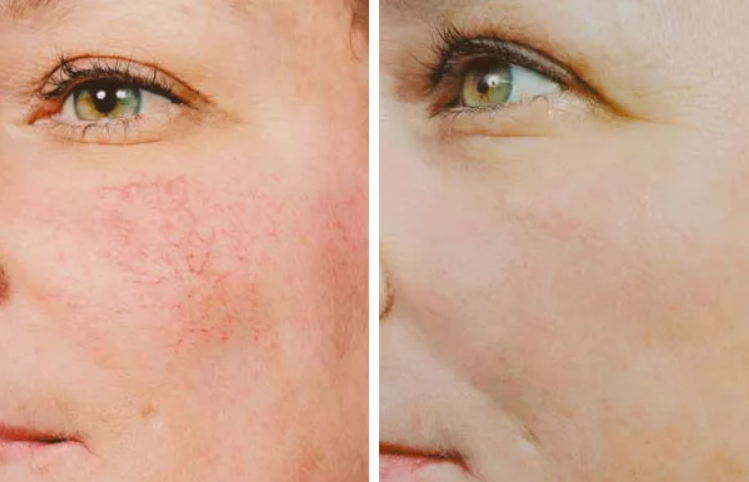 Удаление сосудистой звездочки на лице и носу: отзывы про лазером и током