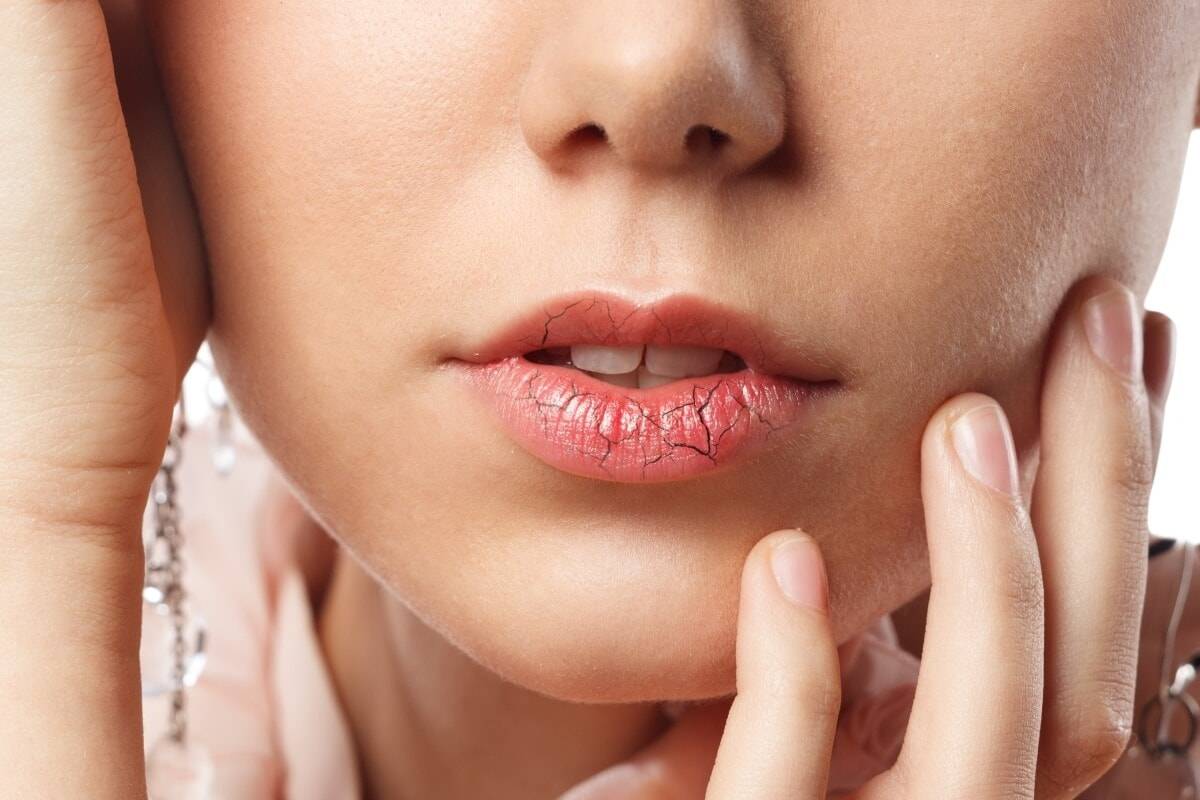 Трещины на губах: выясняем возможные причины и своевременно лечим