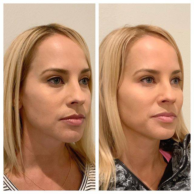 Контурная пластика лица — фото до и после