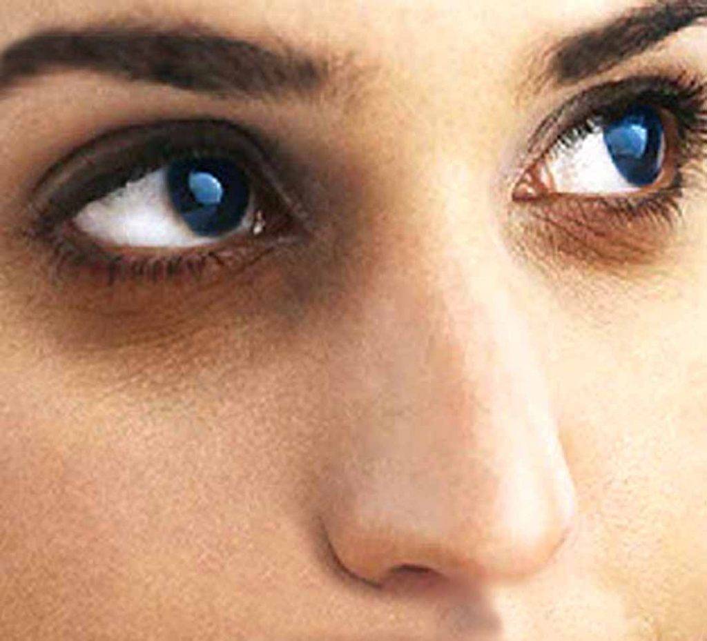 Почему появляются синяки под глазами и как от них избавиться