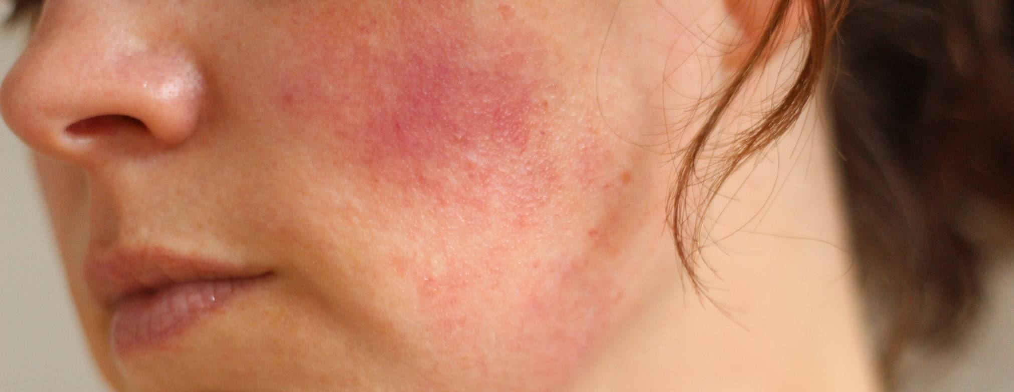 Холодовая аллергия на лице: причины, разновидности, лечение с продукцией бренда pleyana