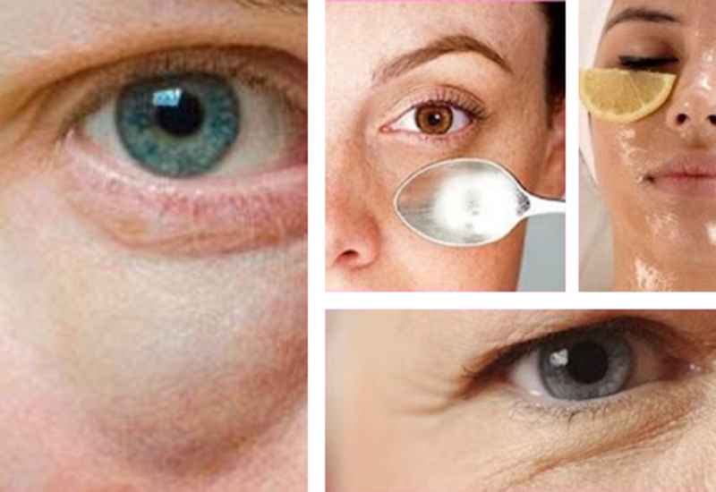 Как убрать темные круги под глазами быстро, причины появления синяков под глазами
