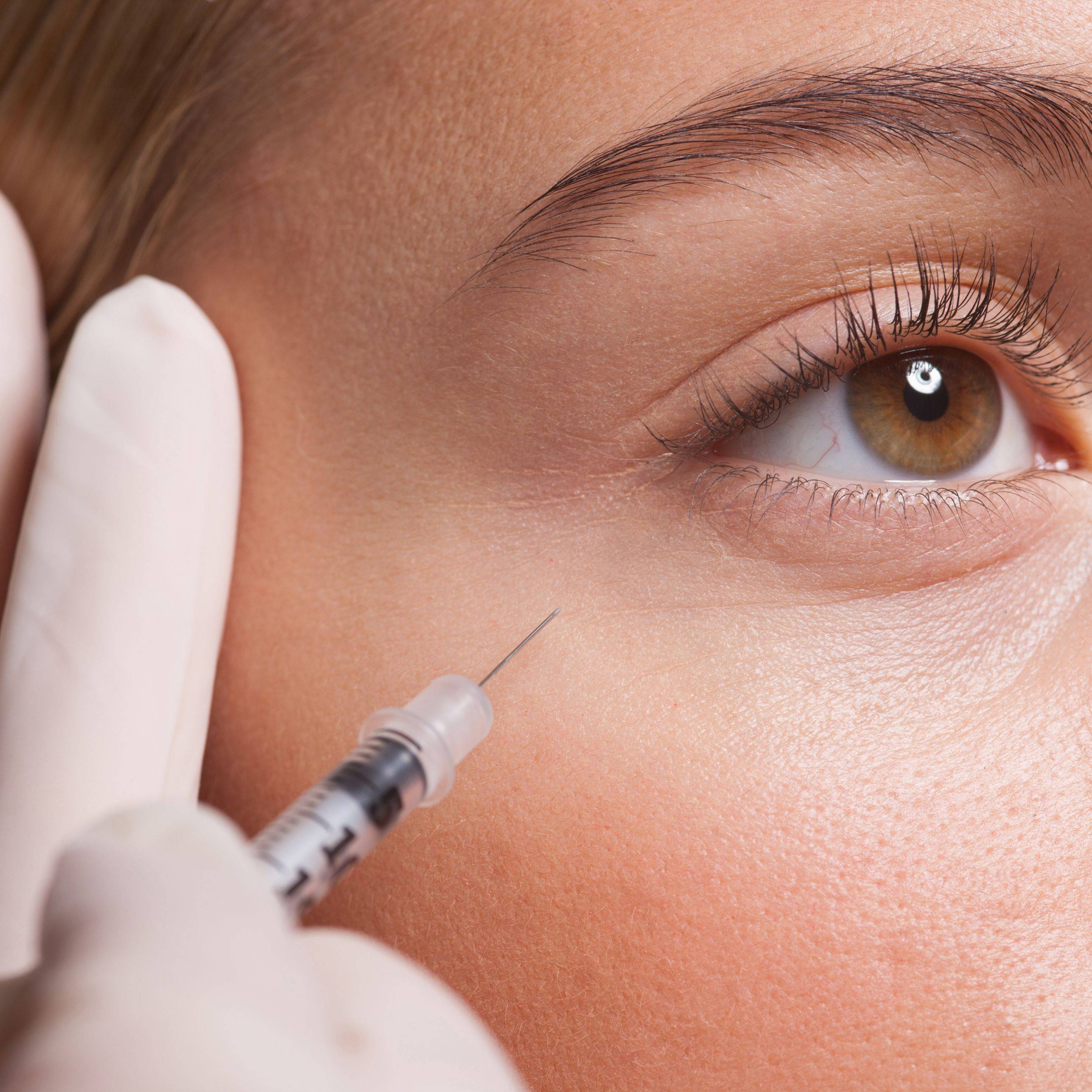 Как убрать синяки под глазами: косметология и процедуры в салонах красоты такие как филлеры, мезотерапия, блефаропластика, липолифтинг