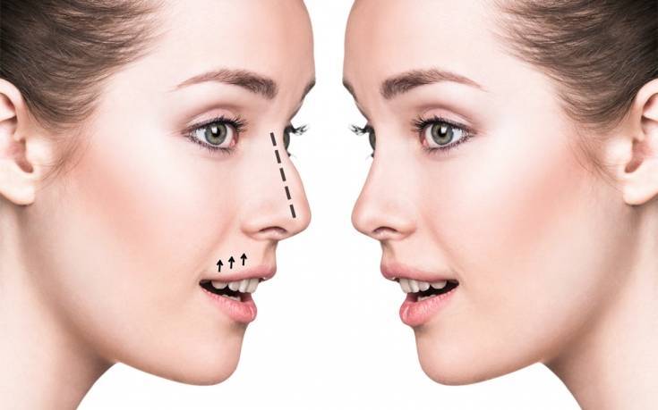 Как исправить нос картошкой: хирургические и неинвазивные методы. нос "картошкой" - методы коррекции