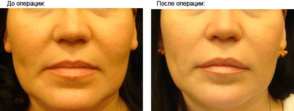 Коррекция носогубных складок на лице