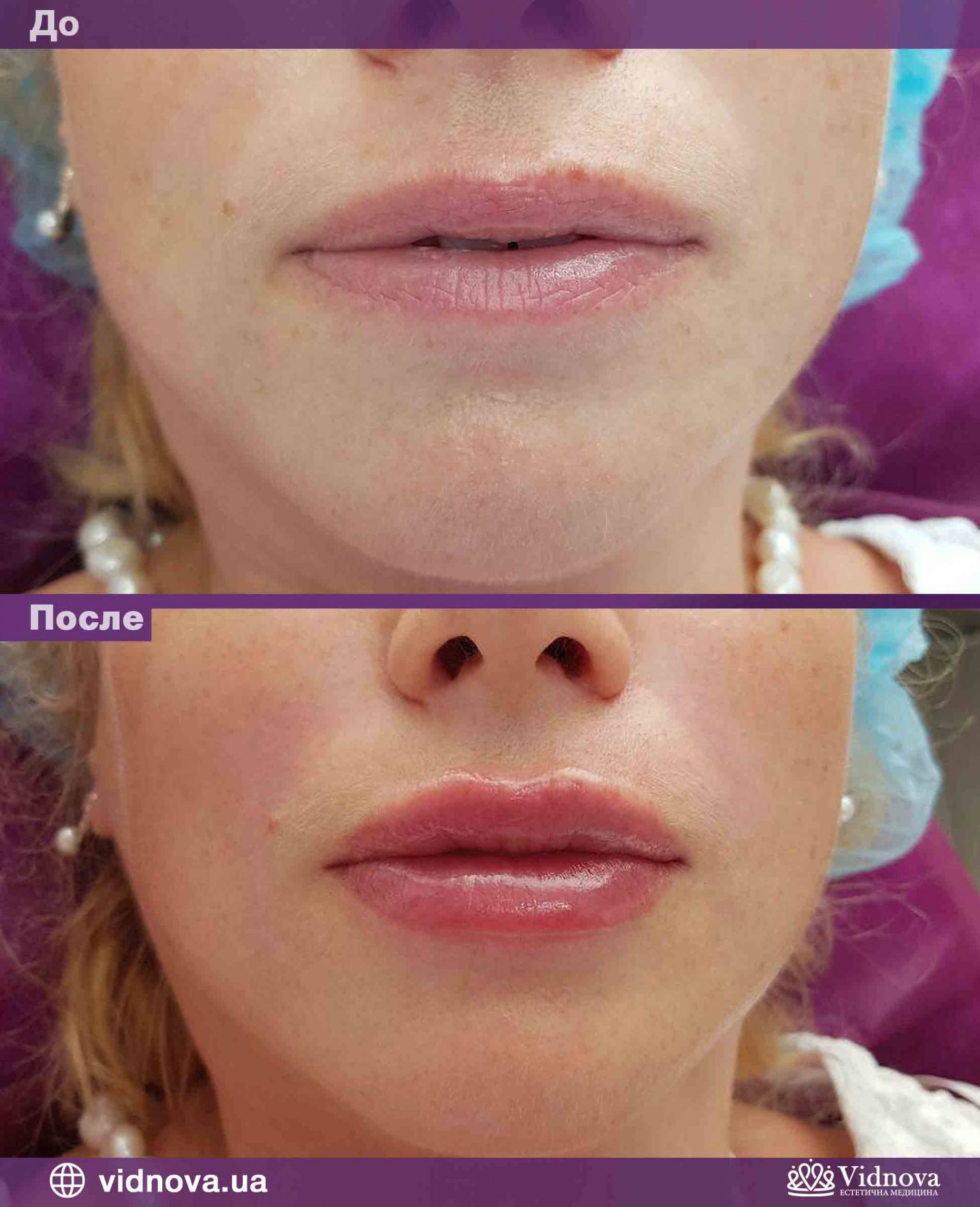 Контурное увеличение губ фото до и после