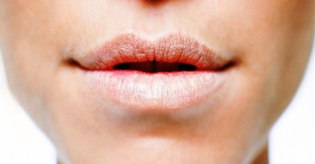 Причины почему сохнут и трескаются губы у мужчин и женщин, что делать?