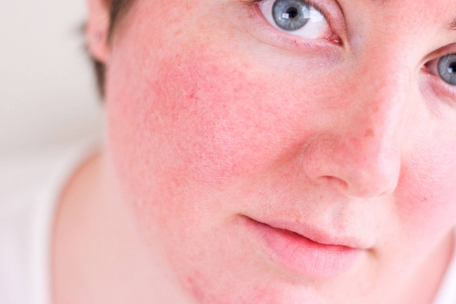 Дерматит на лице. лечение себорейного дерматита на лице.