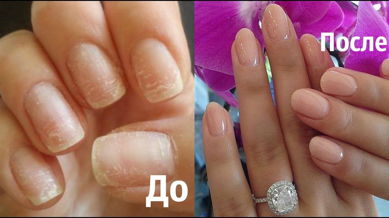 Методы восстановления ногтей после наращивания