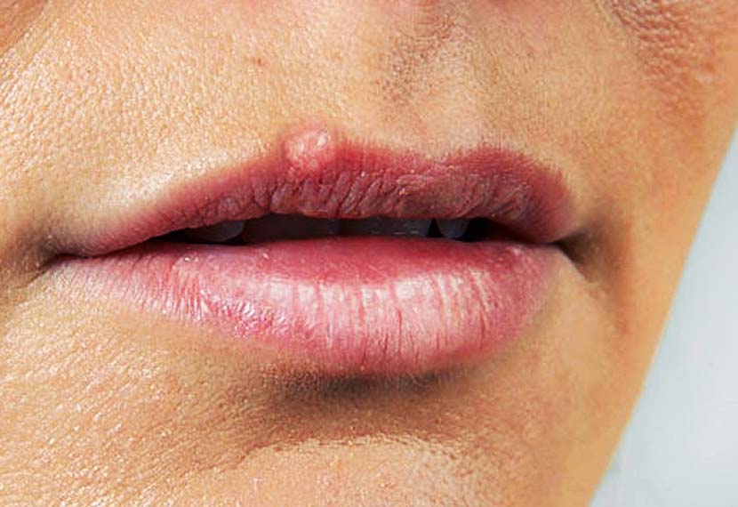 Герпес на губах: симптомы и лечение – напоправку – напоправку