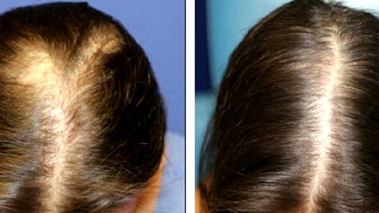 Помогает ли дарсонваль от выпадения волос для женщин