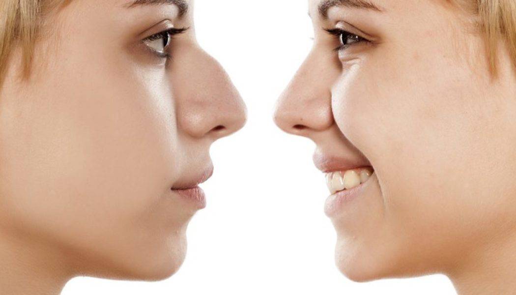 Нос с горбинкой: причины, симптомы, диагностика и лечение