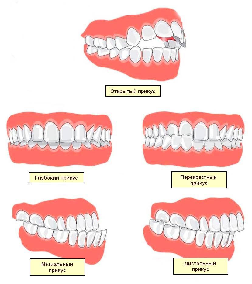 Улучшение выравнивания зубов
