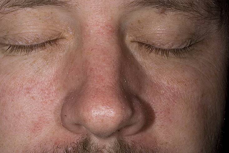 Как избавиться от атопического дерматита на лице?