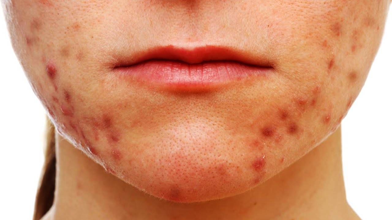 Прыщи на щеках у женщин: гормональные причины | романов георгий никитич