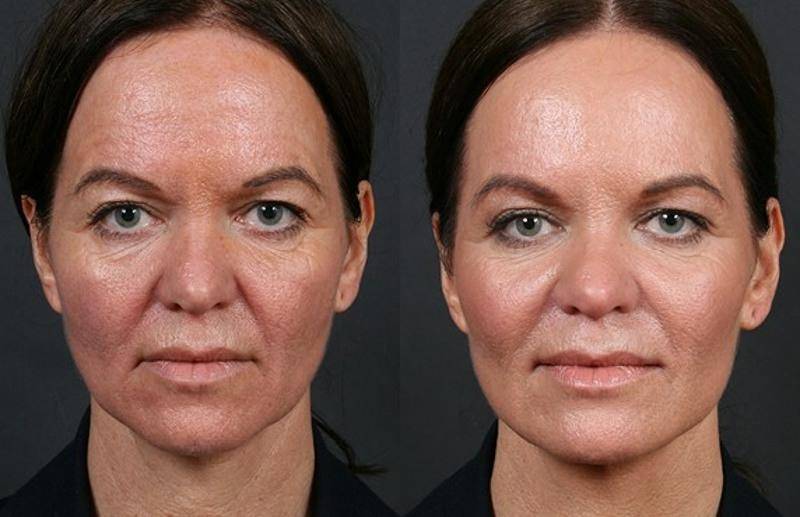 Химический пилинг кожи лица и тела
