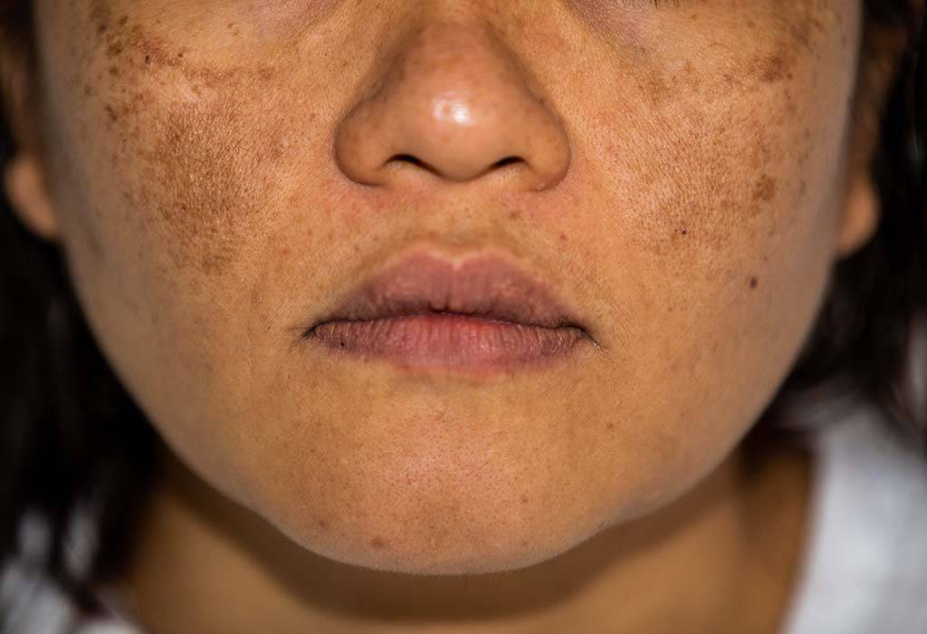Гиперпигментация кожи: причины, лечение