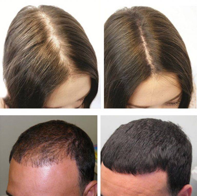 Как восстановить волосы на голове?
