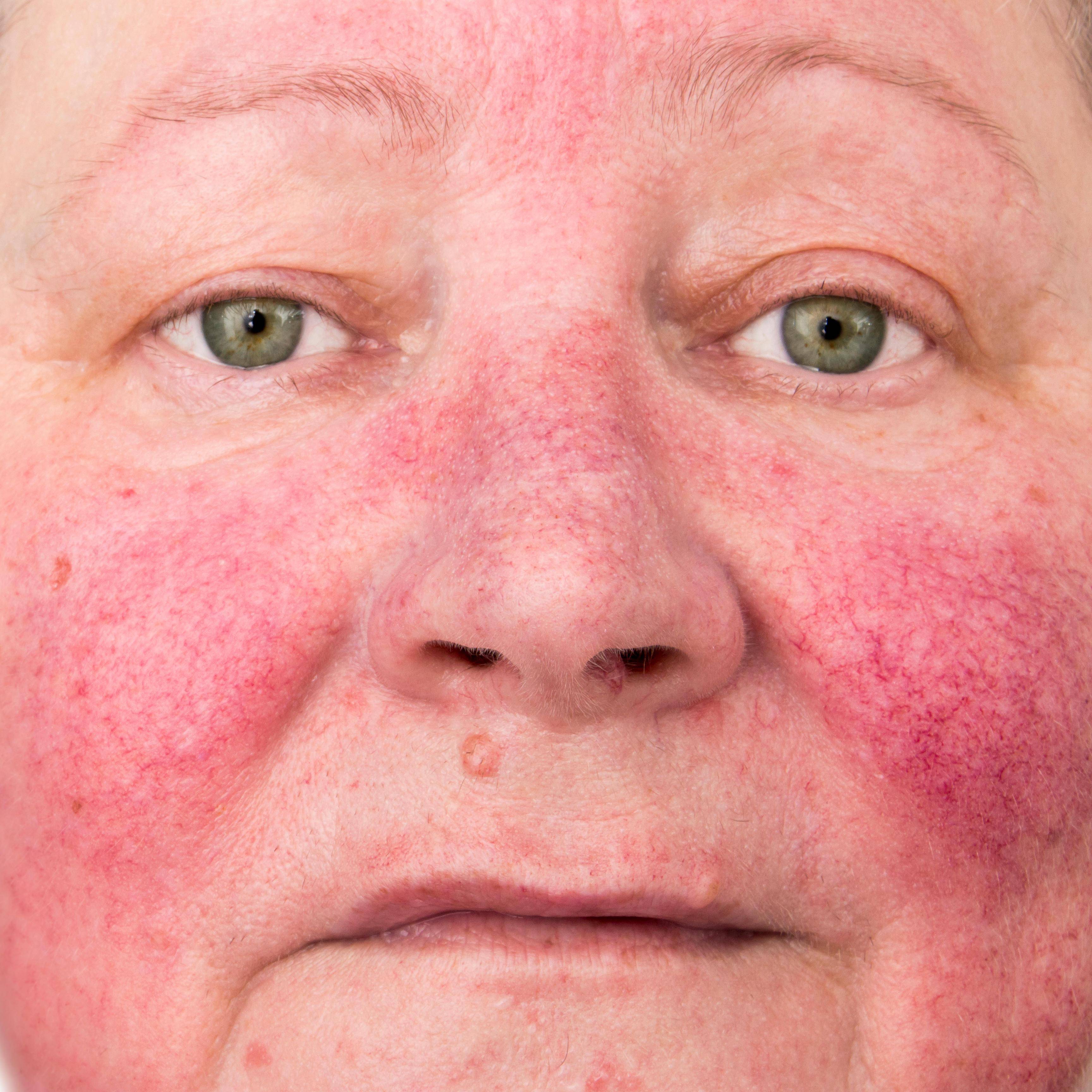 Покраснение на коже — что может вызвать данный симптом
