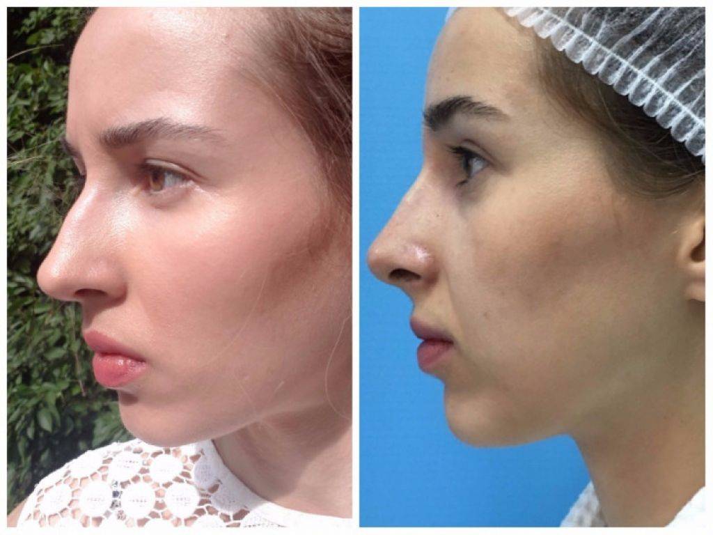 Гиалурон в нос фото до и после