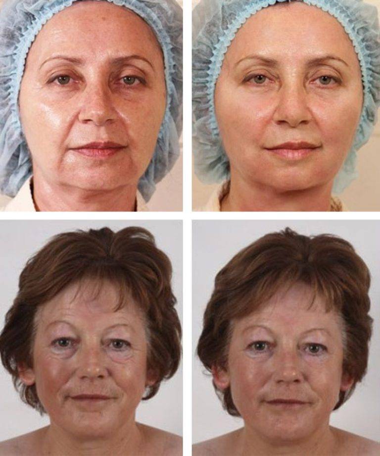 Золотые нити для лица: результат, фото до и после, риски