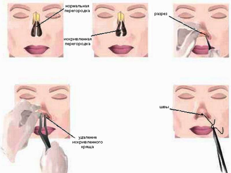 Операции на перегородке носа