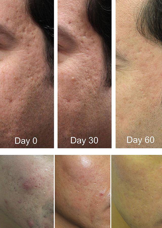 Фракционное омоложение и лечение рубцовых изменений кожи