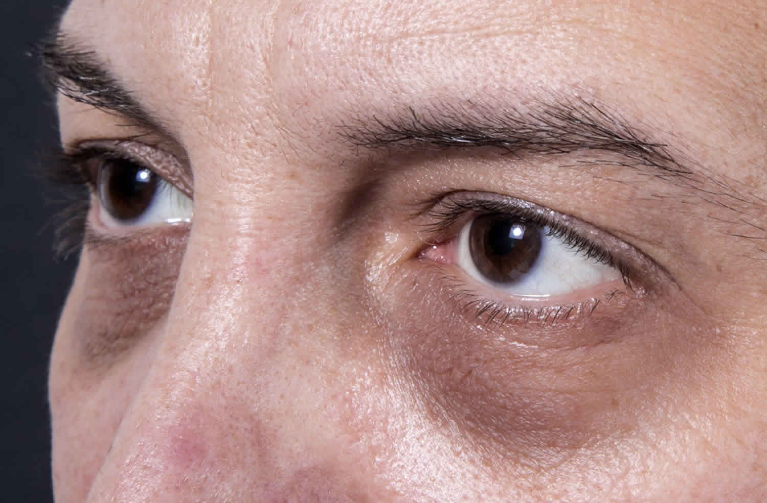 Темные круги под глазами, причины болезни у женщины