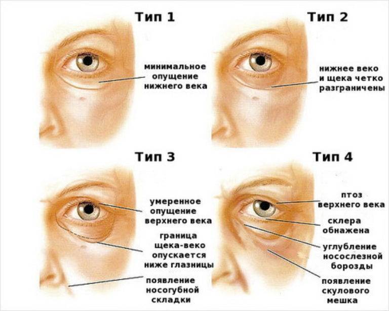 Выворот глазного века. лечение эктропиона глаза в офтальмология