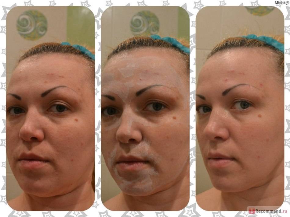 Маска из полисорба: для лица от прыщей, как делать для очищения кожи, как сделать эффект от черных точек - рецепт дерматолога и отзывы