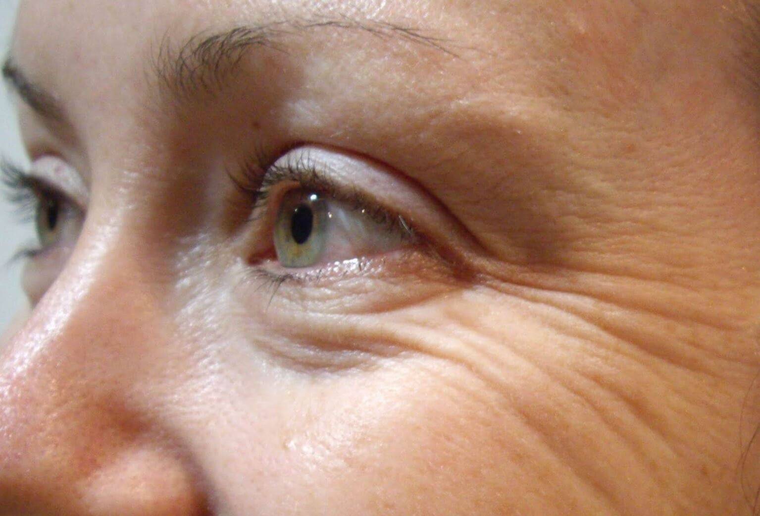 Как убрать морщины под глазами - эффективное избавление от гусиных лапок под глазами
