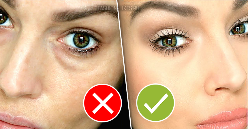 Как убрать темные круги под глазами быстро, причины появления синяков под глазами