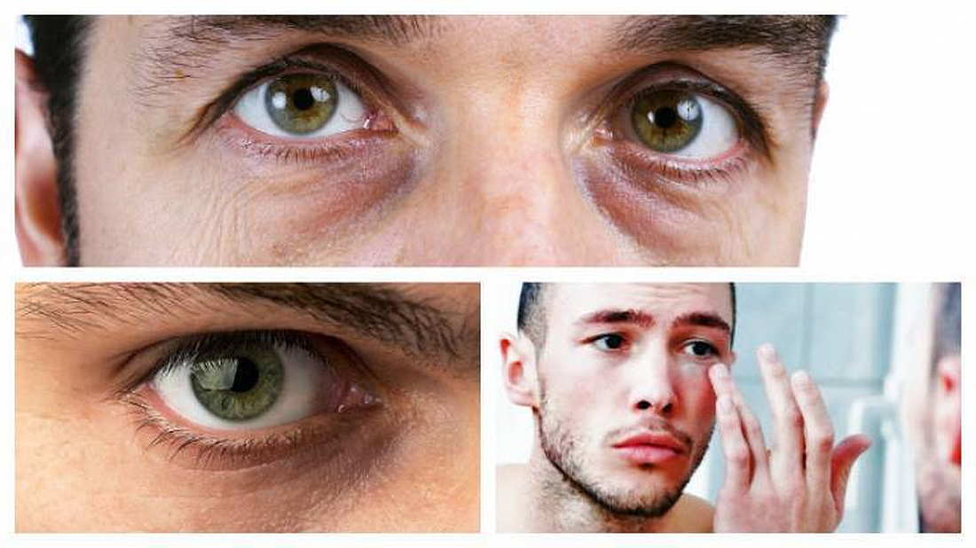 Темные круги под глазами, почему они появляются и какие косметологические процедуры помогают от них избавиться