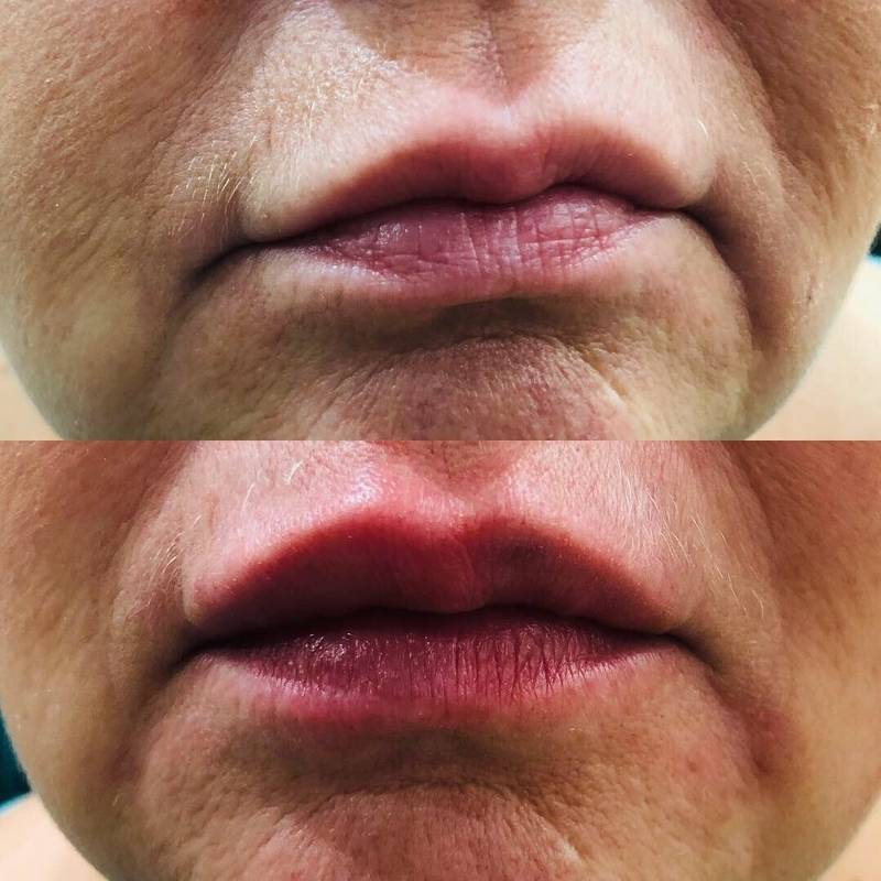 Как убрать мимические морщины вокруг губ? | блог expert clinics