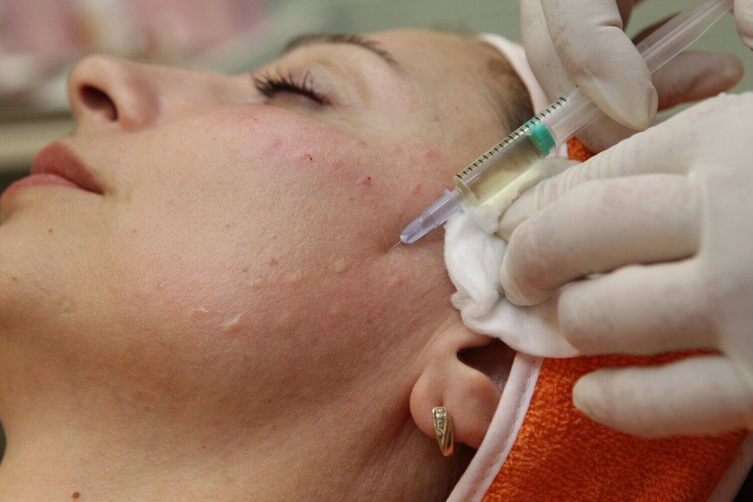 Мезотерапия для омоложения кожи лица | а клиника