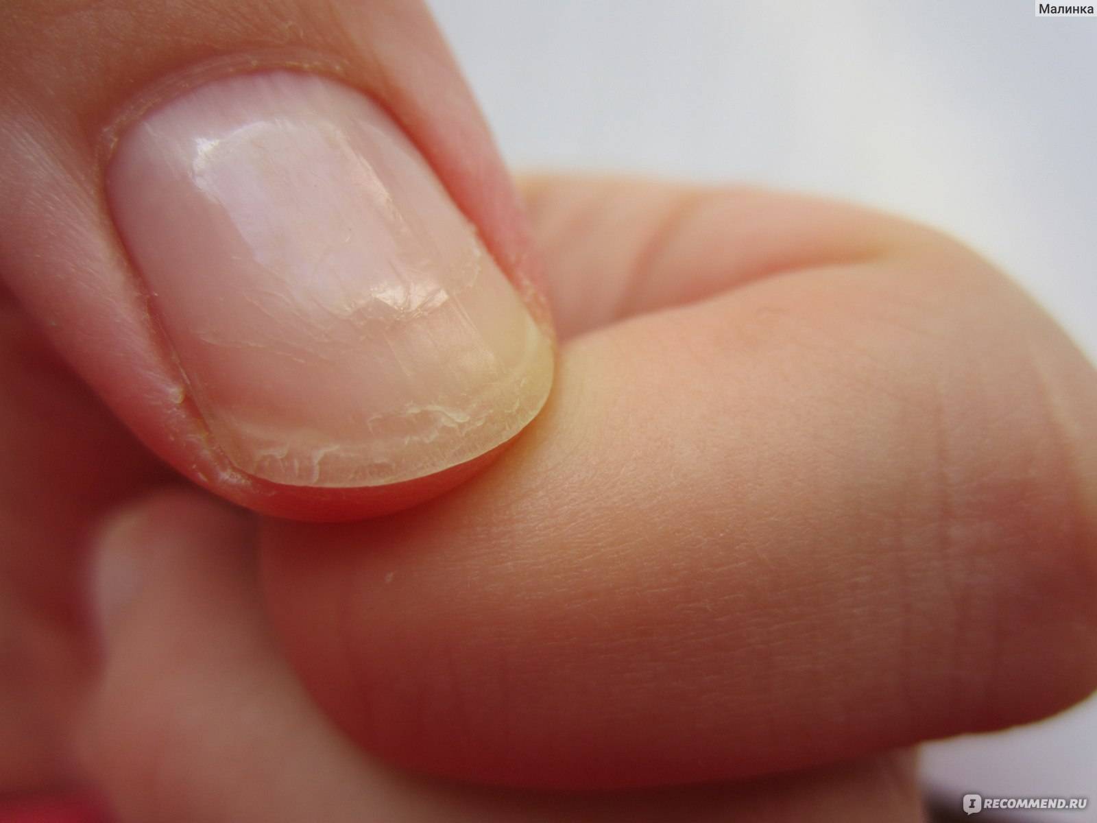 Псориаз на ногтях - как лечить, причины и симптомы заболевания