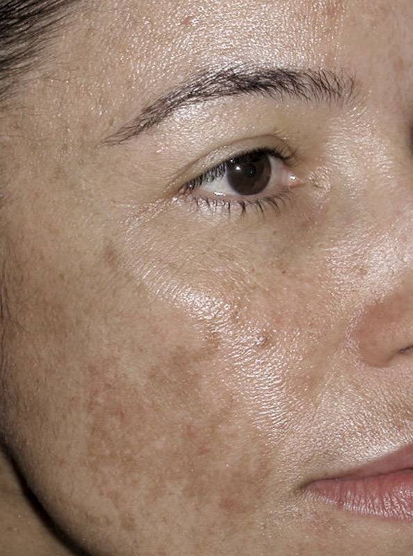 Как убрать пигментные пятна на лице после солнца: как избавиться от пигментации на коже, чем лечить, как отбелить и вывести, почему появляются пигменты, что делать - причины, лечение и фото