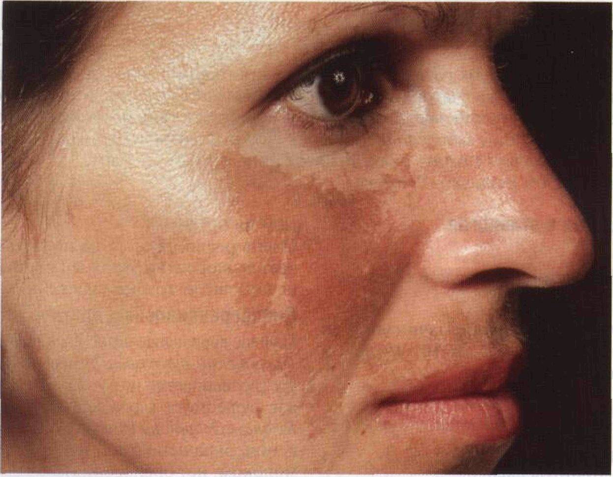 Депигментация кожи (витилиго). отчего на коже появляются белые пятна, диагностика и возможные методы лечения