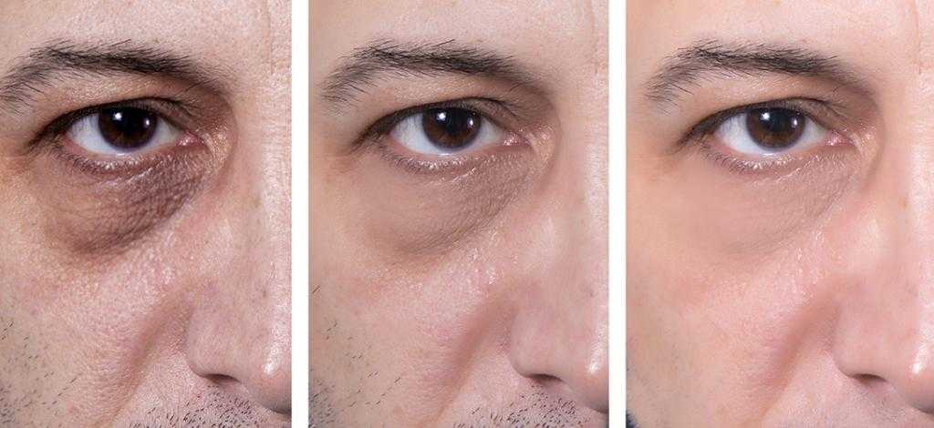 Как избавиться от темных кругов под глазами. до и после фото. - косметология доктора корчагиной