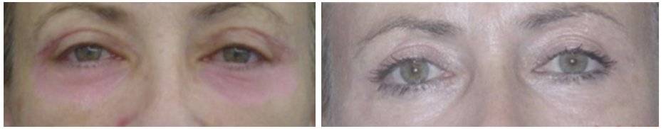 Ретробульбарная гематома после блефаропластики как выглядит