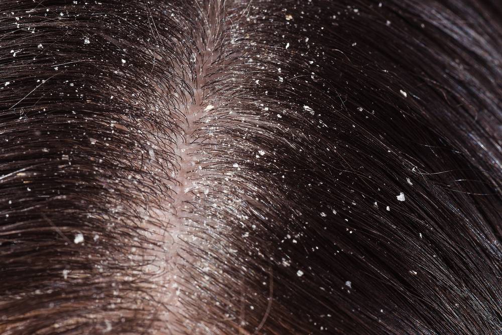 Лечение сухой себореи кожи головы