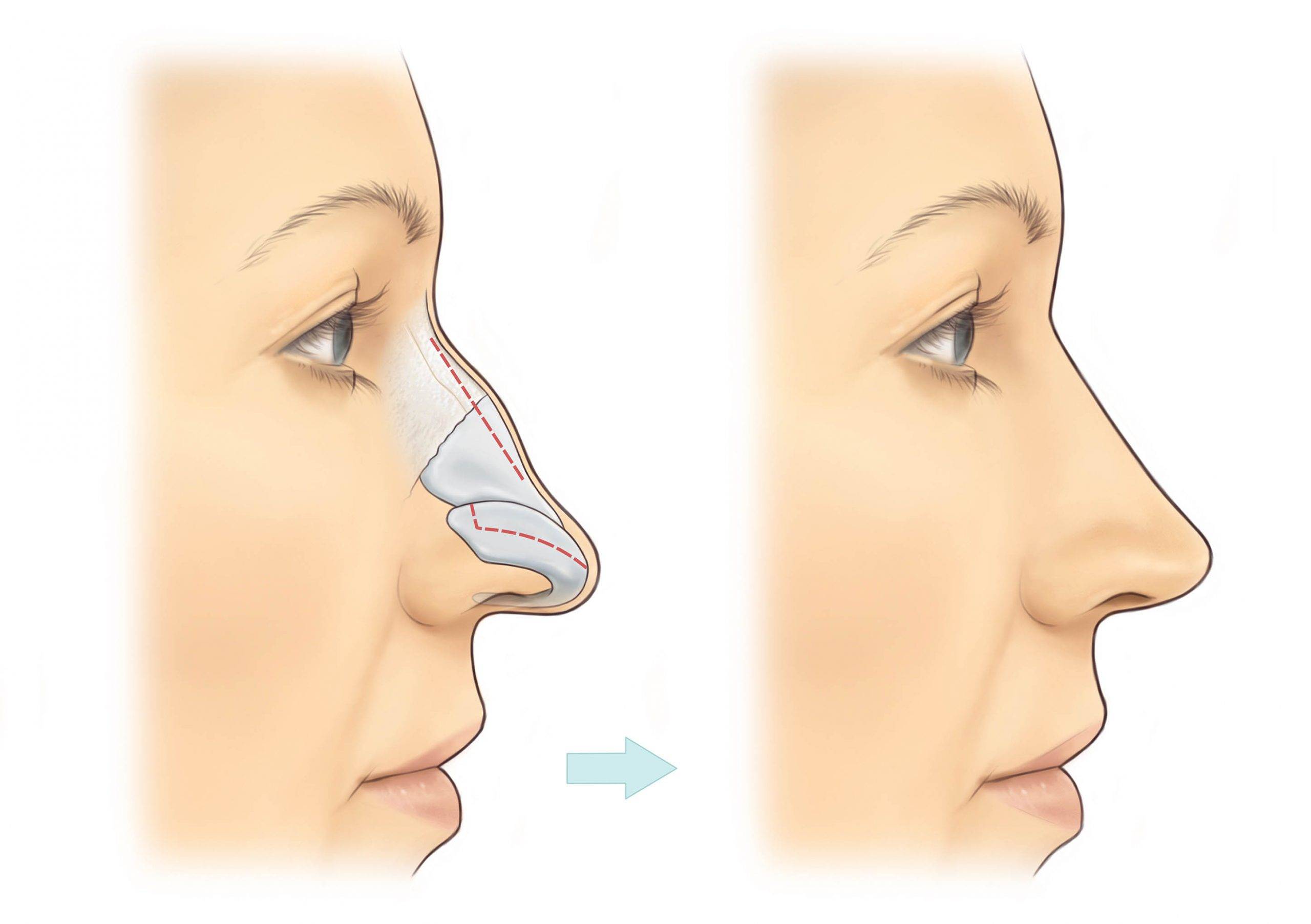 Искривление перегородки носа: симптомы и оперативное лечение