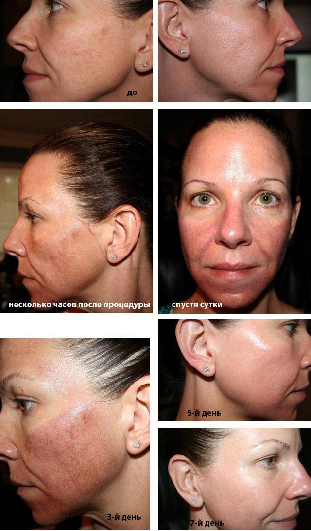 ???? лазерный пилинг кожи лица: эффект от пилинга лазером, показания и противопоказания