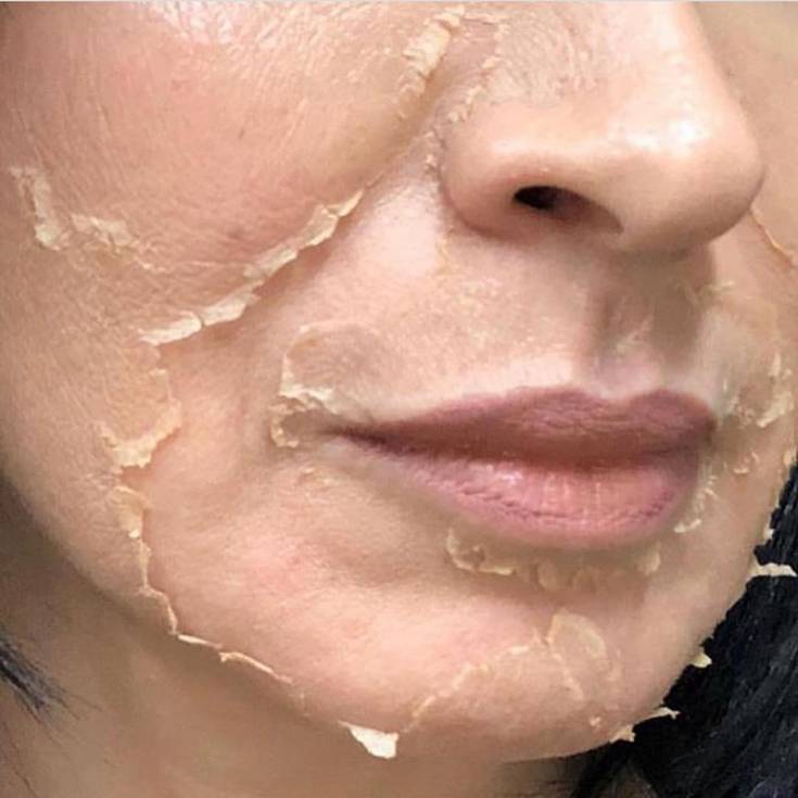 Постпилинговый уход: как правильно ухаживать за кожей лица после различных пилингов