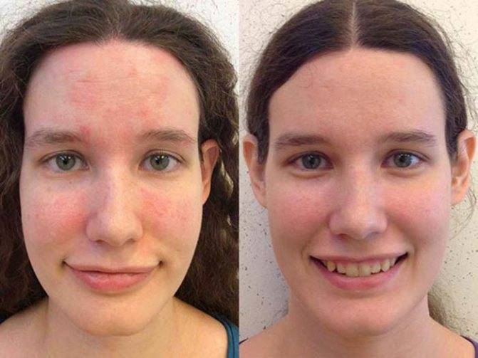 Псориаз на лице — болезнь или испытание, как и чем его лечить в домашних условиях